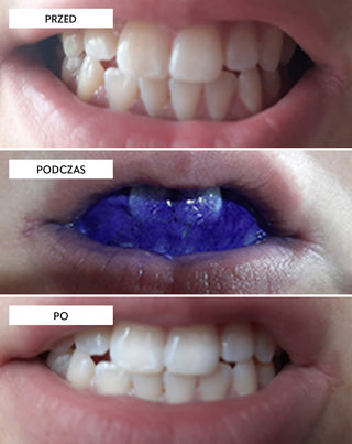 Korektor farby, sérum korigujúce odtieň zubov White Bite Smilebite 30 ml